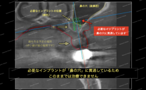 サイナスリフトという骨再生・造成を行わないと、鼻の穴に貫通してしまいます